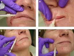 Процедуры омоложения.