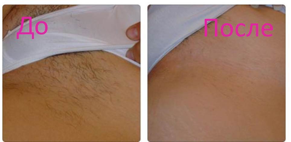 Ревалюционный спрей для удаления волос