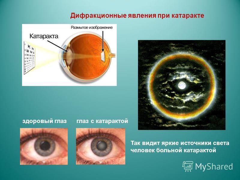 Если в глазах расплывается изображение что значит