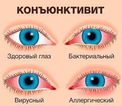 Виды конъюнктивита и способы лечения