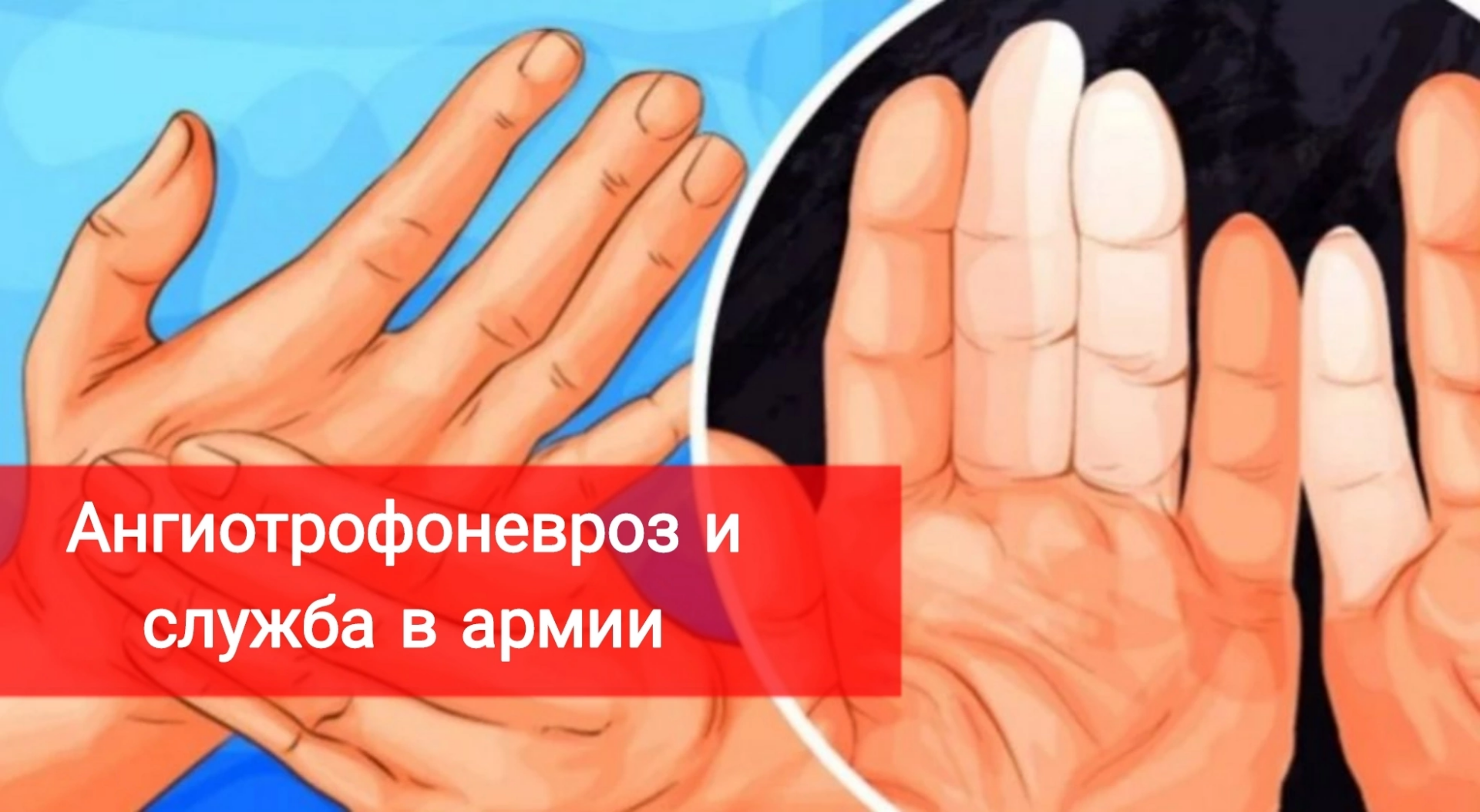 Синдром рейно что это такое простыми