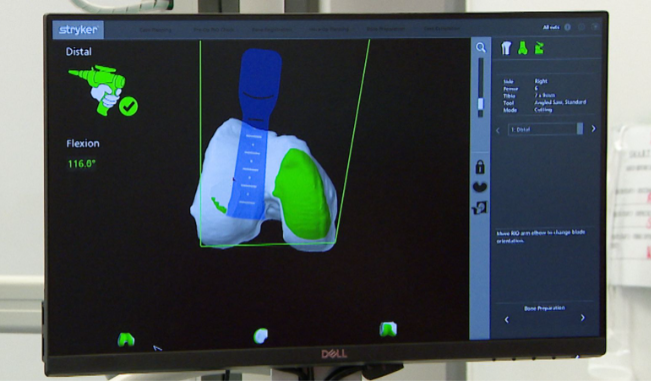 «Это означает, что каждый день — лучший день в хирургии»: роботизированная рука помогает при замене коленного сустава.