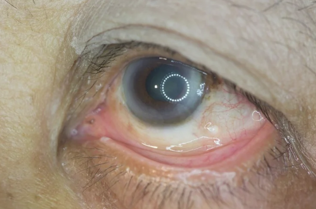 Роль кофеина в профилактике диабетической ретинопатии