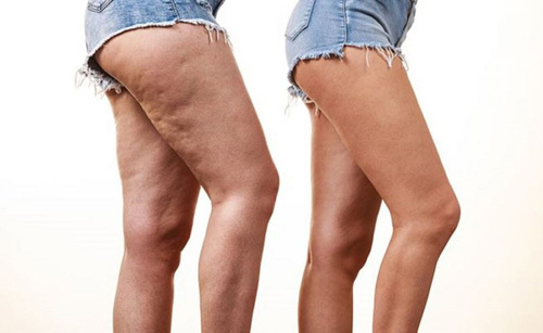 Хотите избавиться от целлюлита? Попробуйте эти методы
