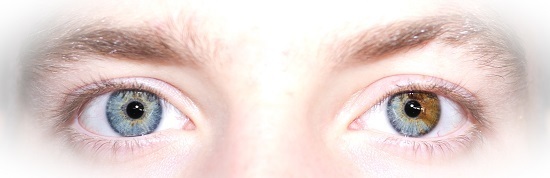 Что такое частичная гетерохромия обоих глаз?