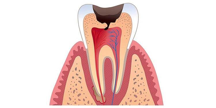 Заболевание зубов - кариес