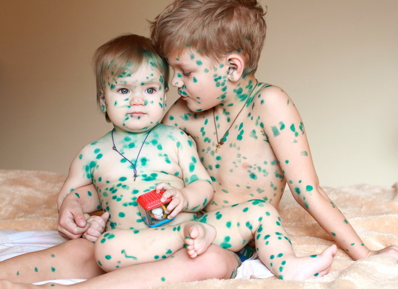 В России пропала вакцина против ветрянки.