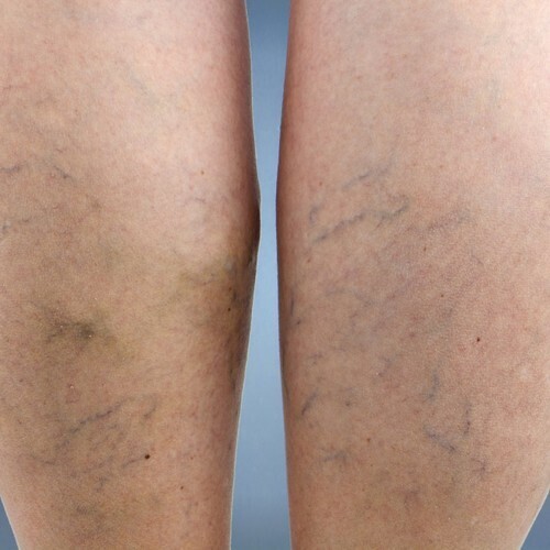 Натуральные средства от варикозного расширения вен нижних конечностей