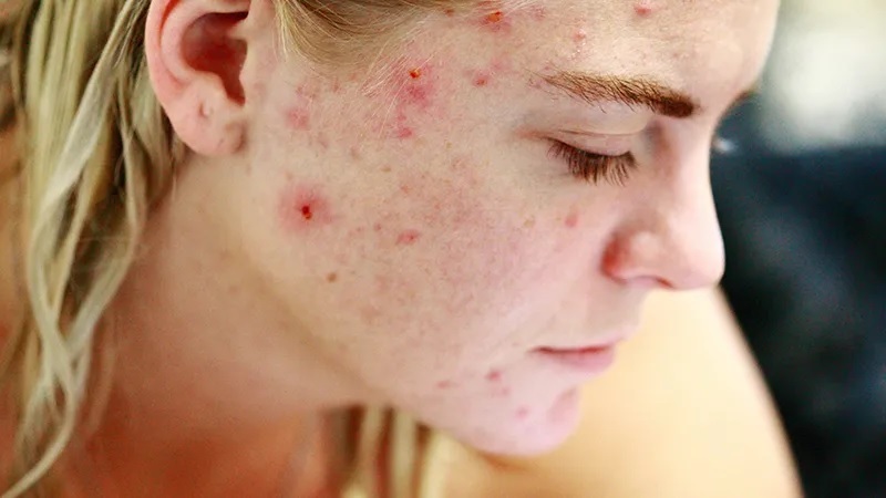 Ученые открыли механизм борьбы с бактериями, вызывающими акне