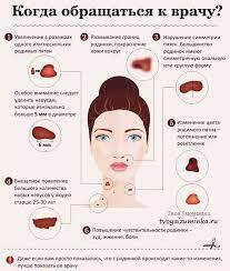 Появление родинки- чем это опасно?