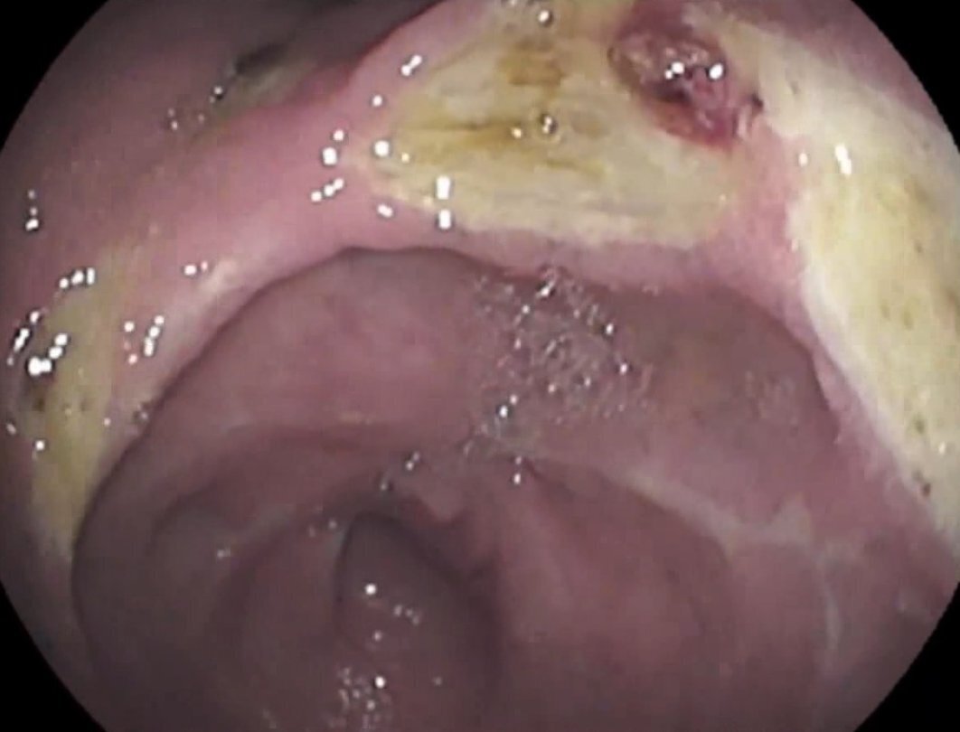 Боитесь гастроскопии?! Не её вам нужно бояться!!!