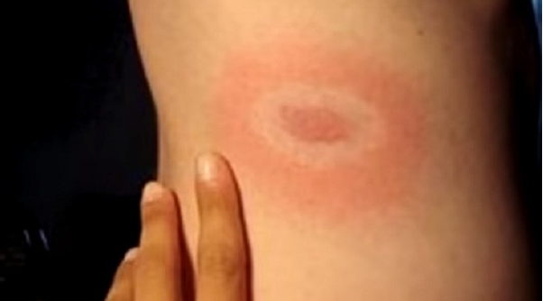 Первая помощь при укусе клеща| Клещевой энцефалит симптомы| Виды клещей