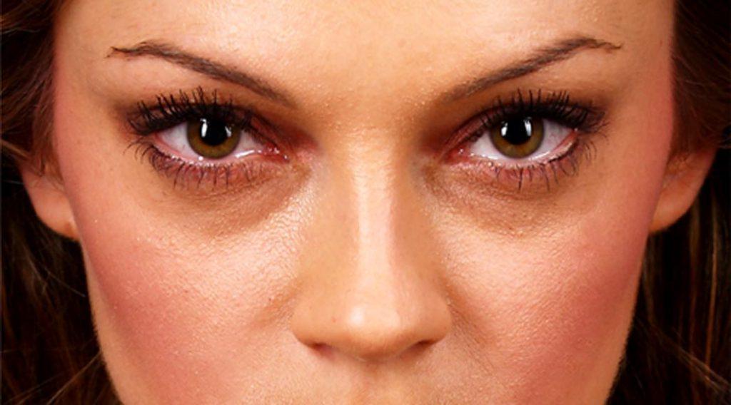 Способы избавления от дефекта темных кругов под глазами