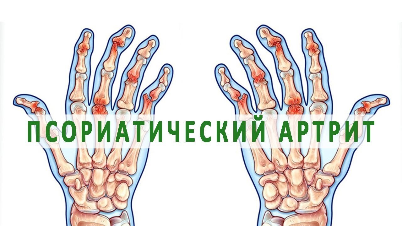 Секреты здоровья суставов при артрите: как облегчить боль и улучшить подвижность