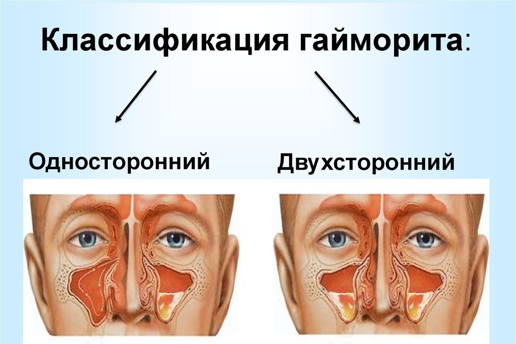 Р картина двухстороннего гайморита