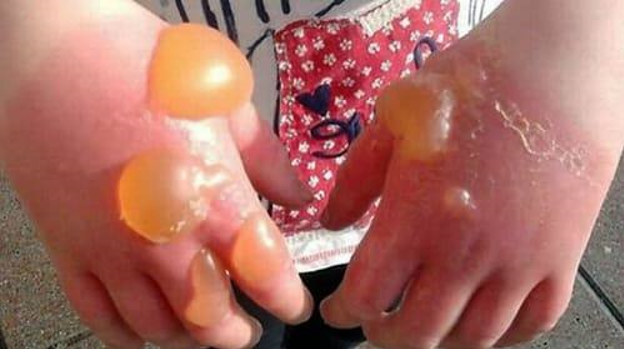 Смертельно ядовитый борщевик Сосновского. Откуда он появился и как не пострадать от него?