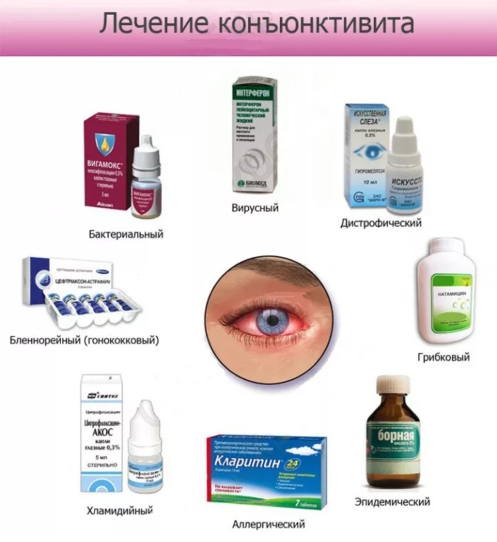 Конъюнктивит мкб. Лекарство от вирусного конъюнктивита у взрослых капли. Аллергия конъюнктивит капли для глаз. Капли при бактериальном конъюнктивите у детей. Средства при конъюнктивите у детей препараты.