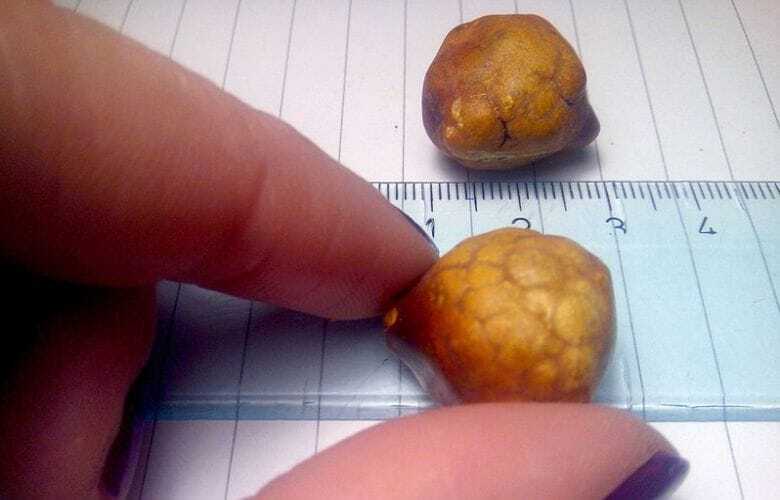 7 различных типов «камней», которые могут образовываться в вашем теле