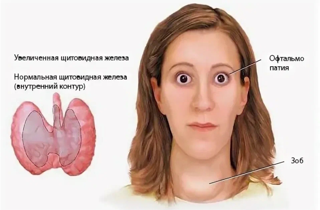 Как выглядит щитовидка у женщин в картинках