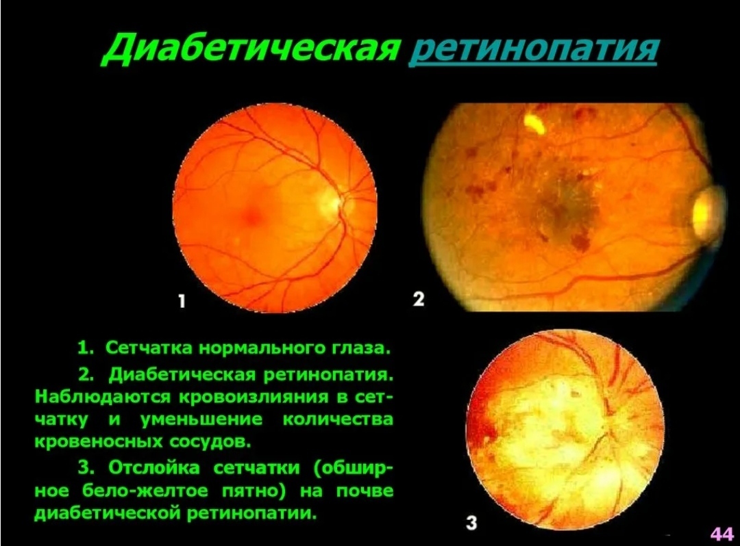 Диабетическая ретинопатия картинки