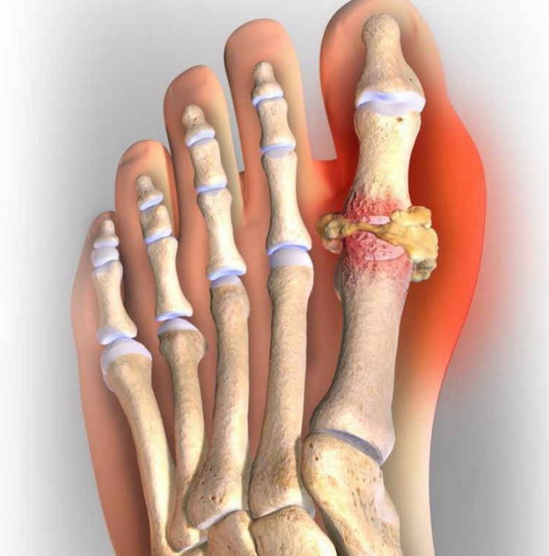 На зарядку становись! Ох, подагра берегись!