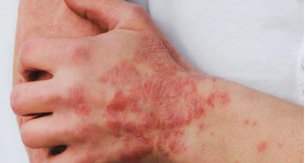 Солнце — одно из лучших природных средств от псориаза.