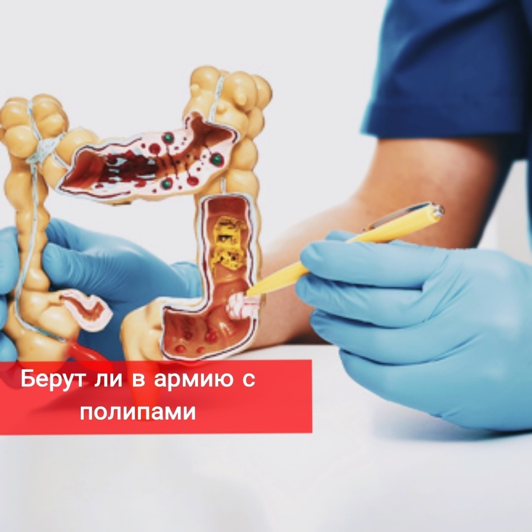 Берут ли в армию с полипами