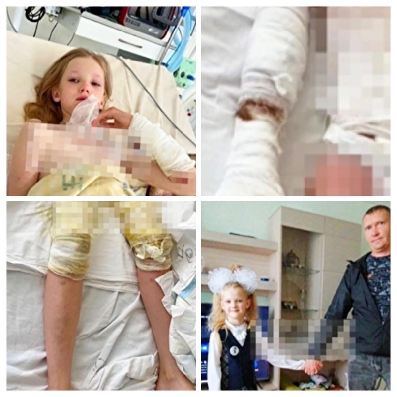 Папашкин друг обварил все туловище принцессы на гулянке.