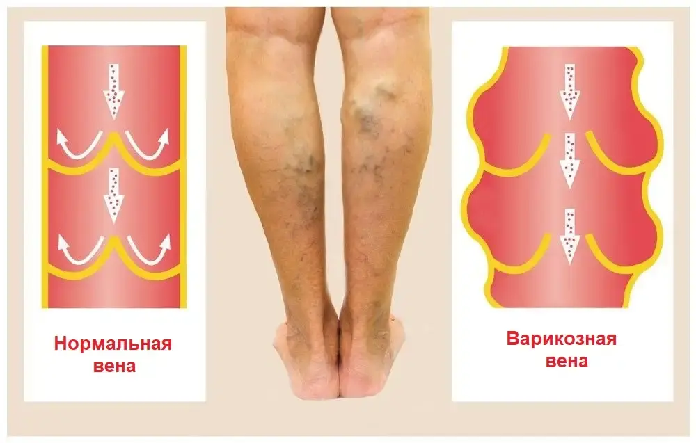 Варикозные вены: Причины и эффективное лечение