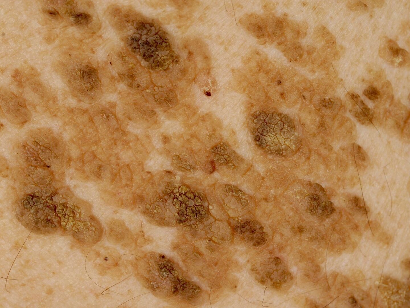 Страшное Заболевание? Рак кожи заразен или нет?