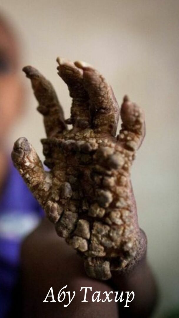 "Абу Тахир из Бангладеш: Символ силы и надежды в борьбе с редким заболеванием"