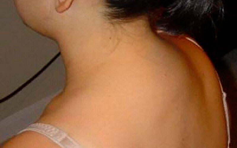 Холка на шее. Одно простое упражнение поможет избавиться от нее