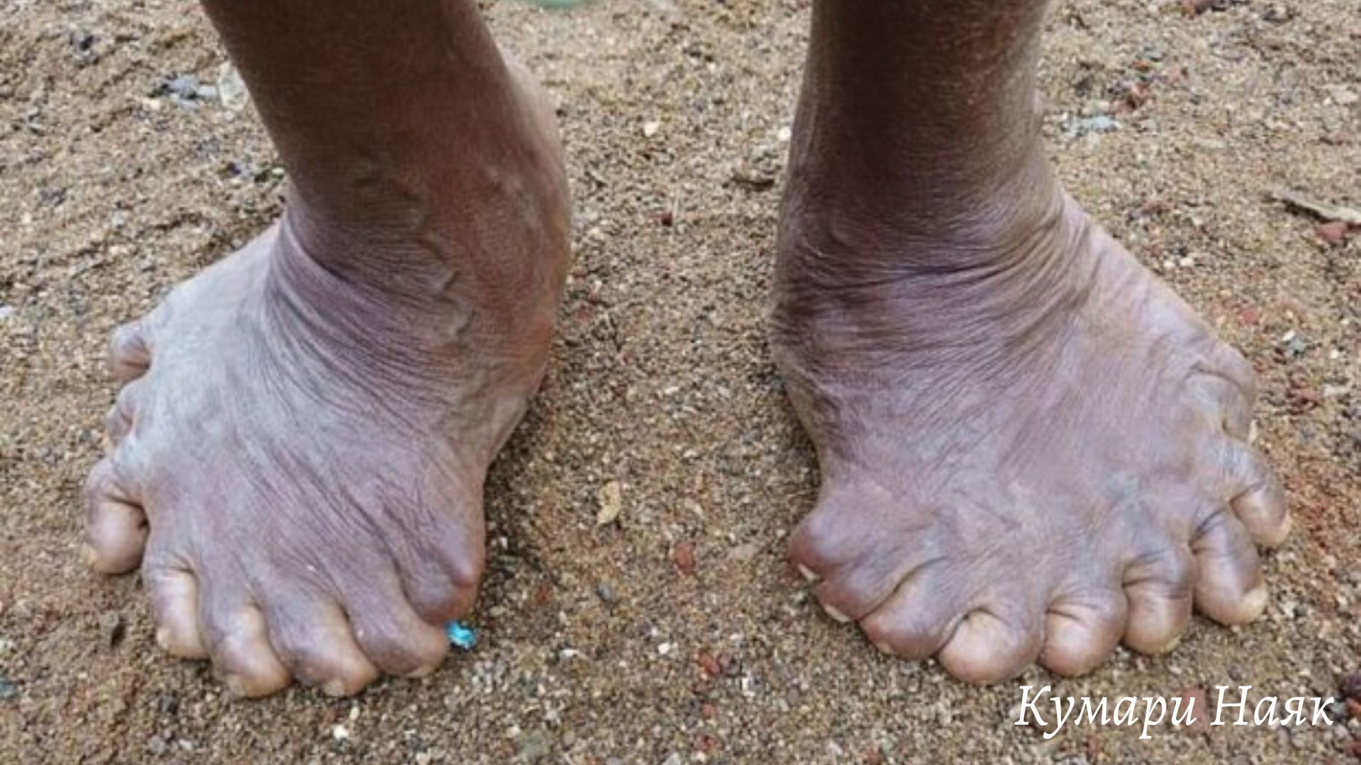 "Пальцы судьбы: Жизненный путь Кумари Наяк с исключительным количеством пальцев"