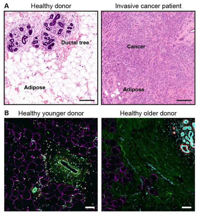 Здоровый жир в молочной железе может защитить от инвазивного рака молочной железы