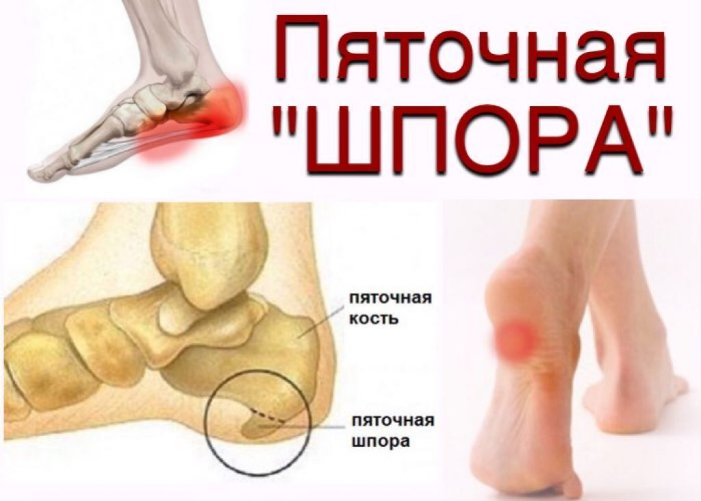 Заболевание пяточной шпоры, эффективные народные рецепты и средства ее лечения