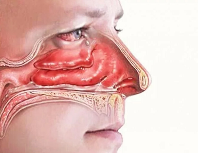Борьба с синуситом с помощью 8 эффективных мер