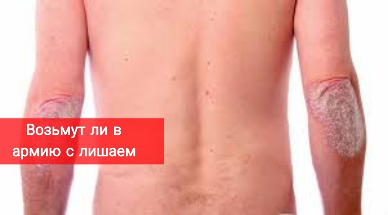 Возьмут ли в армию с лишаем