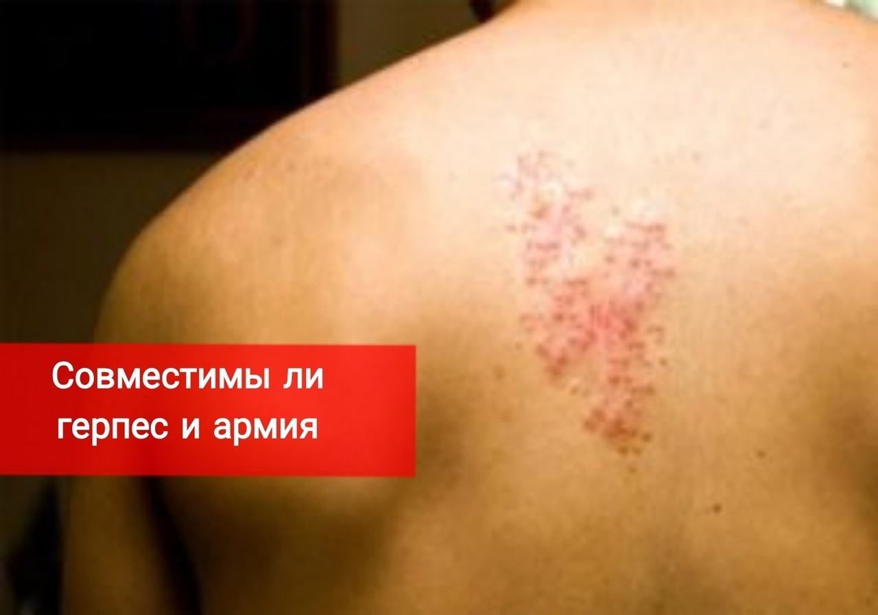 Совместимы ли герпес и армия
