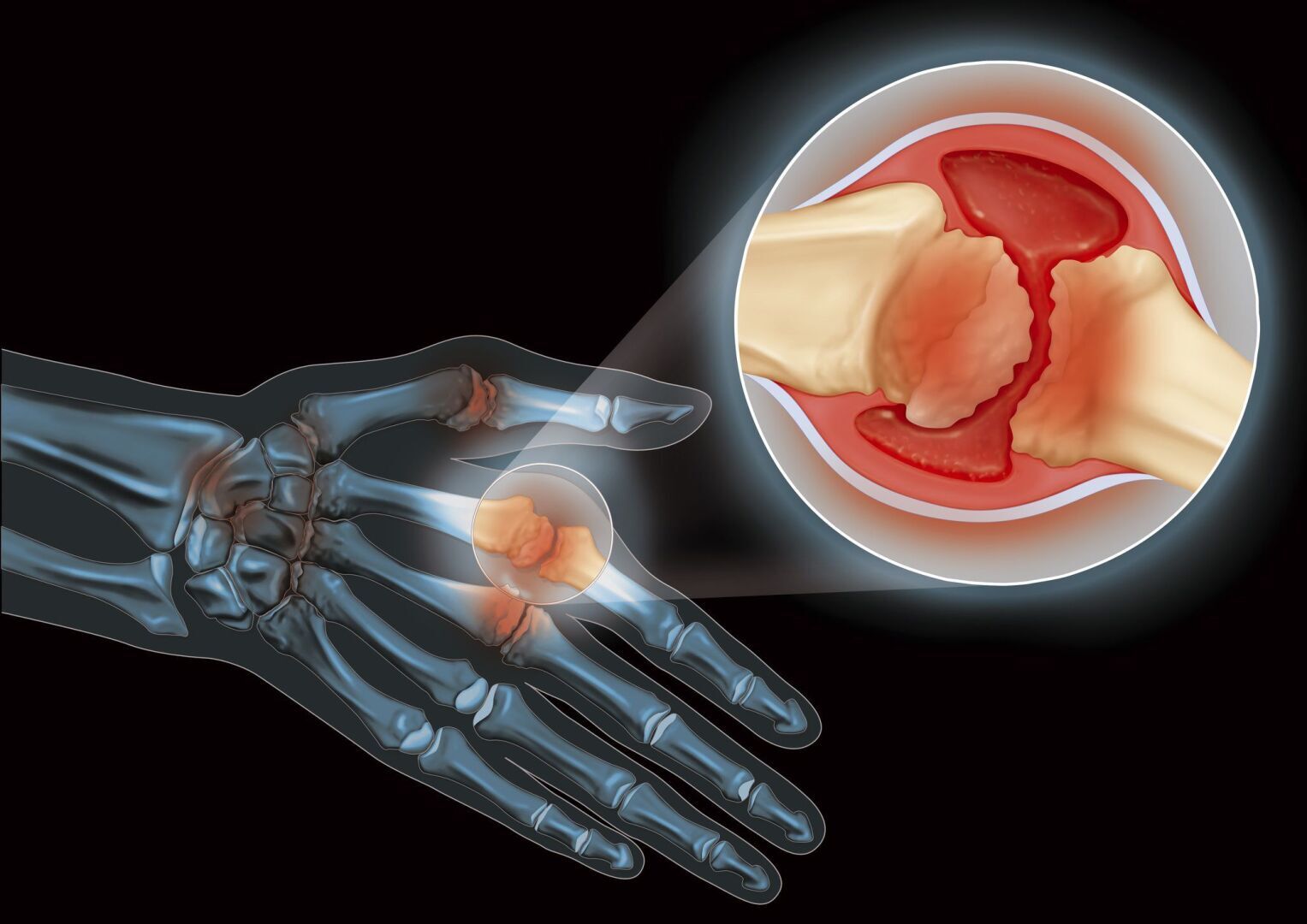 У Вас Артрит? Несколько Очень Полезных Советов.