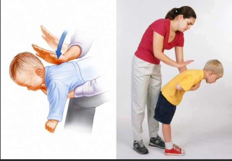 Что делать если ваш ребенок подавился едой. Как помочь?