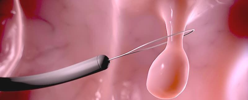 Полипы – доброкачественные образования народные средства лечения внутренних полипов.