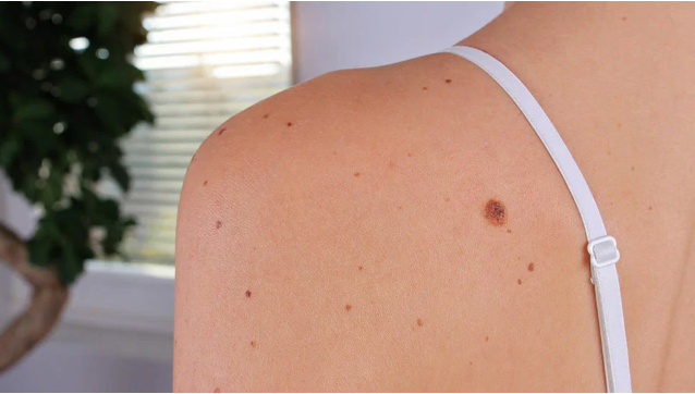 Как удалить родинки, бородавки, угри, теги кожи и возрастные пятна в домашних условиях