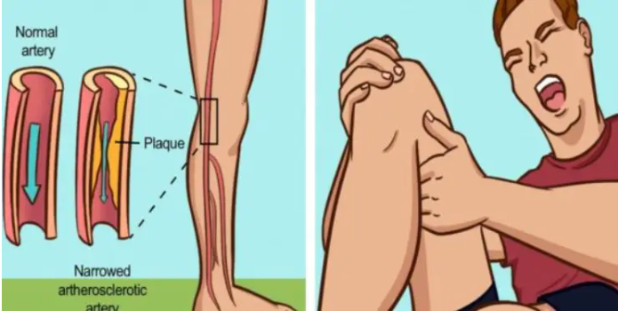 Ранние предупреждающие симптомы, которые могут привести к закупорке артерий