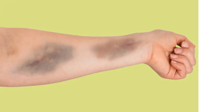 Ранние признаки того, что у вас мало витамина С, и что с этим делать