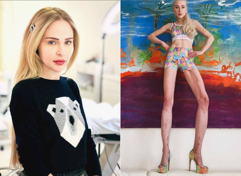 Девушка-модель потратила миллионы долларов на «сломанные кости и увеличение роста на 14 см. Спустя 7 лет она призналась, что сожалеет об этом».