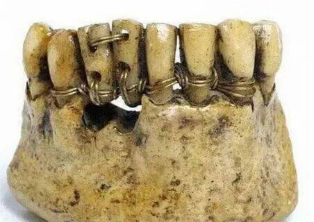 Эволюция зубных протезов: чем заменяли зубы наши предки?