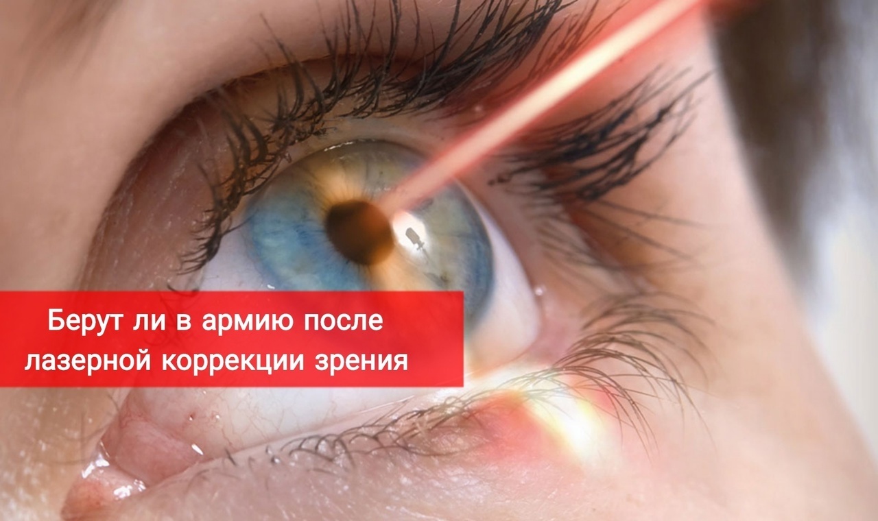 Берут ли в армию после лазерной коррекции зрения