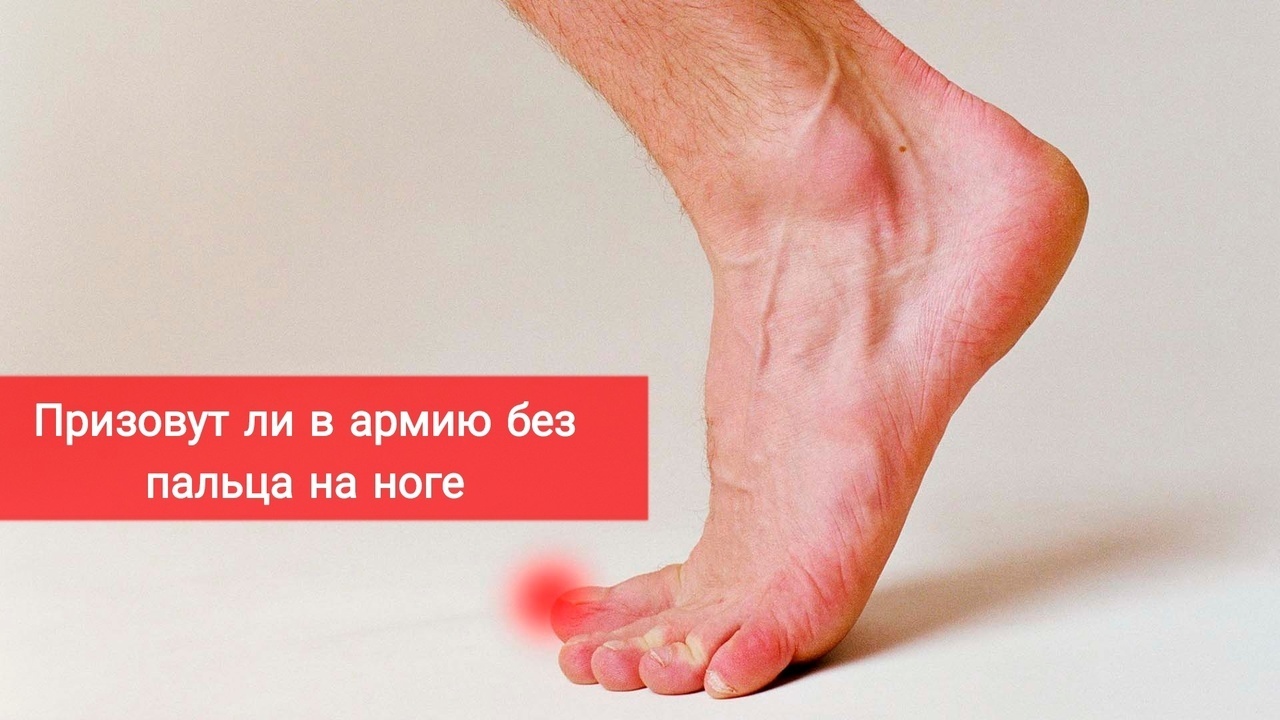 Призовут ли в армию без пальца на ноге