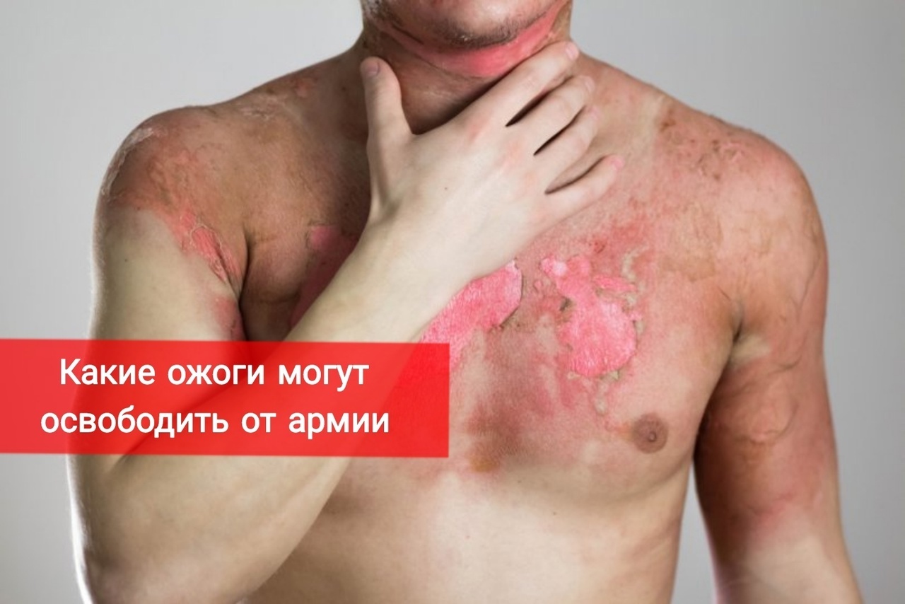 Какие ожоги могут освободить от армии