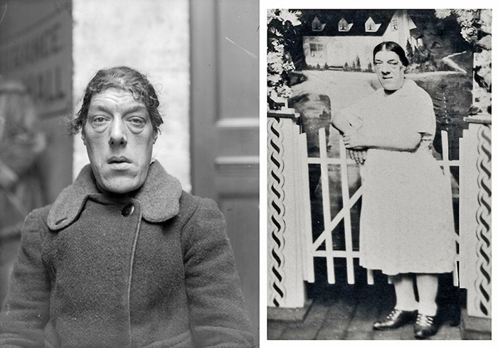 🎇"Самая уродливая женщина в мире". 🎇Трагическая история Мэри Энн Беван (Видео)